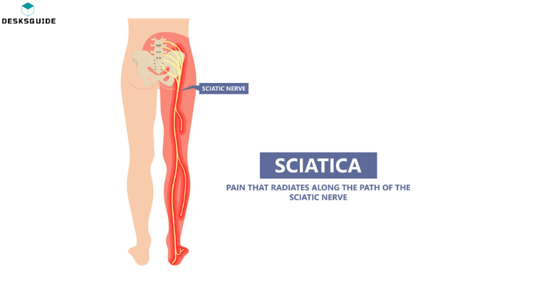 What is Sciatica 